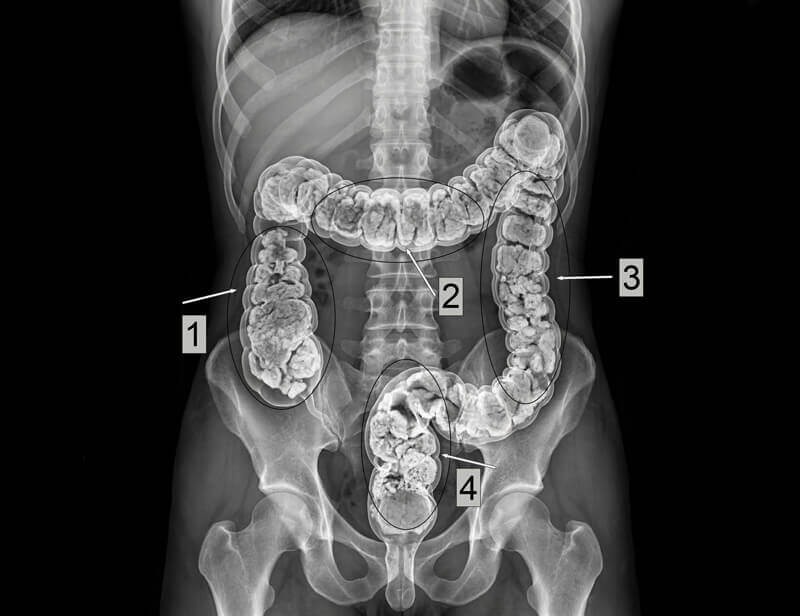 Abdominal X-ray showing severe fecal impaction