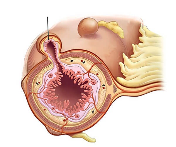 Medical illustration of diverticula in the bowel wall